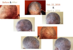 monat_hair_regrowth-norma